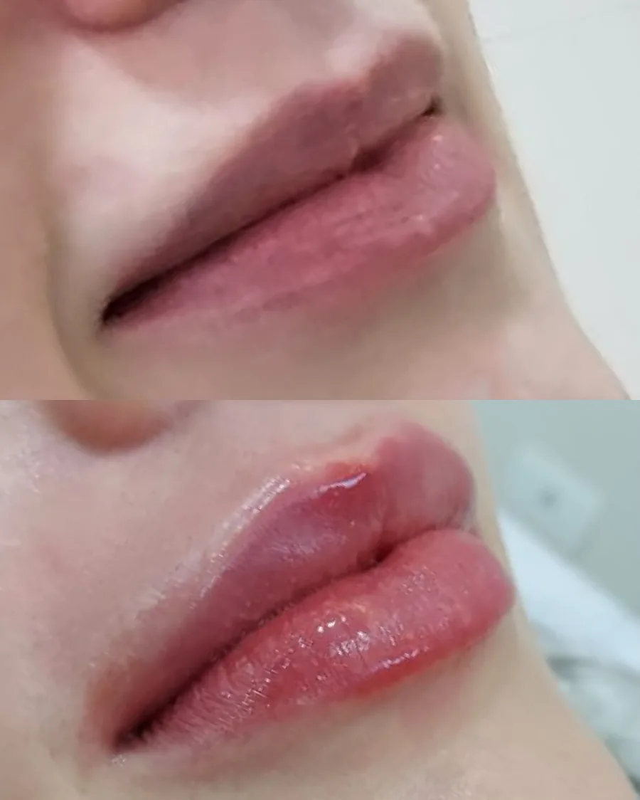 Preenchimento labial, antes e depois (caso 1)