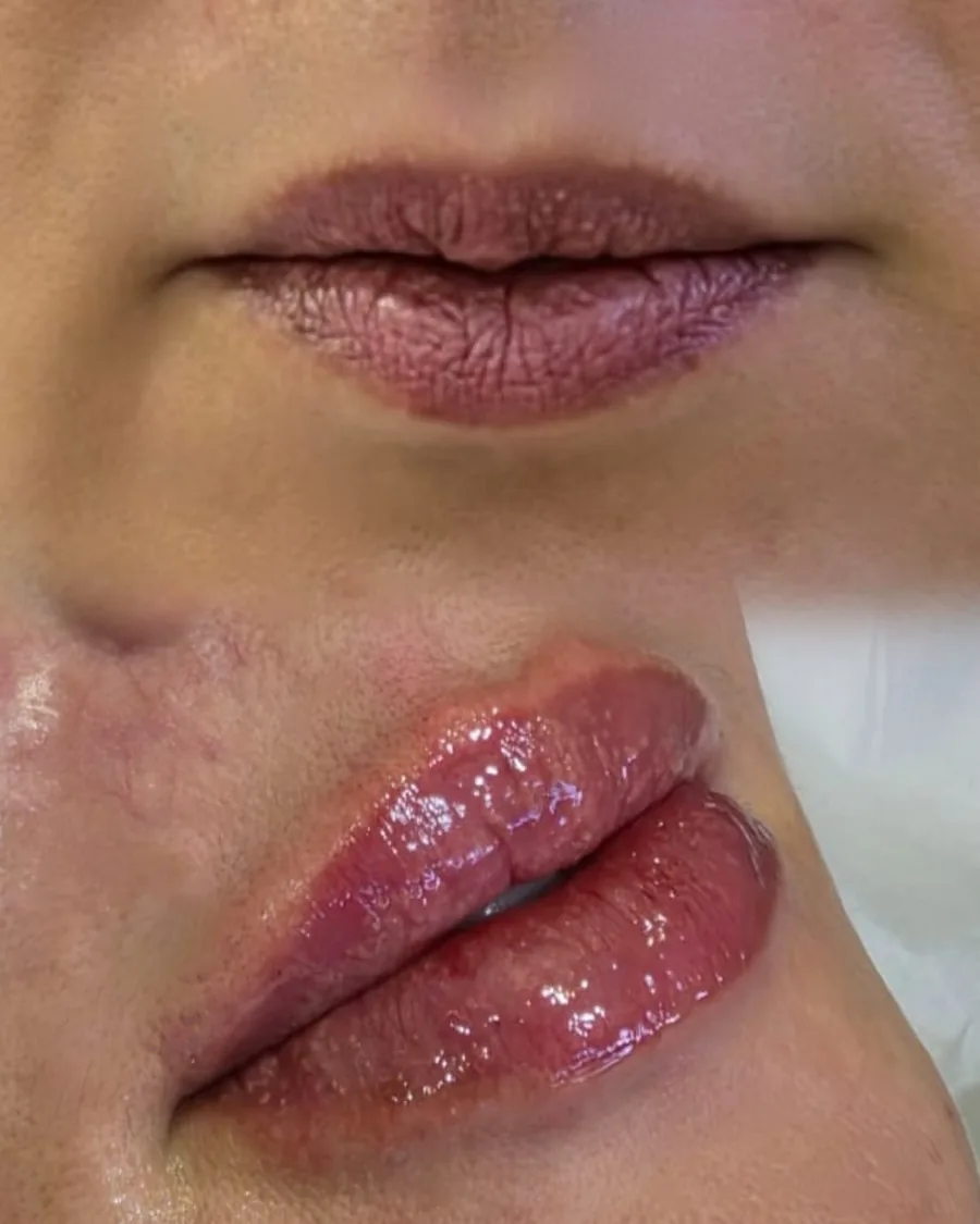 Preenchimento labial, antes e depois (caso 2)