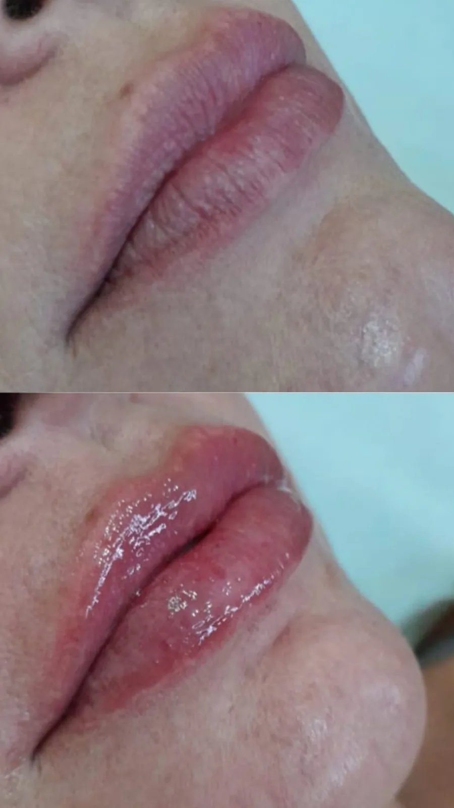 Preenchimento labial, antes e depois (caso 3)