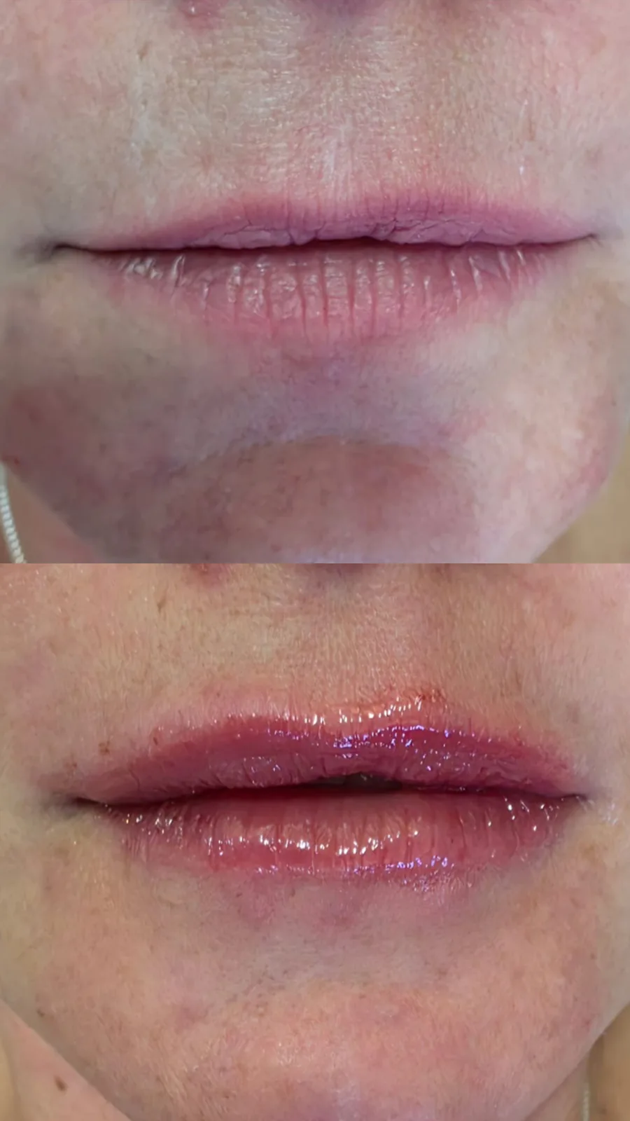 Preenchimento labial, antes e depois (caso 4)